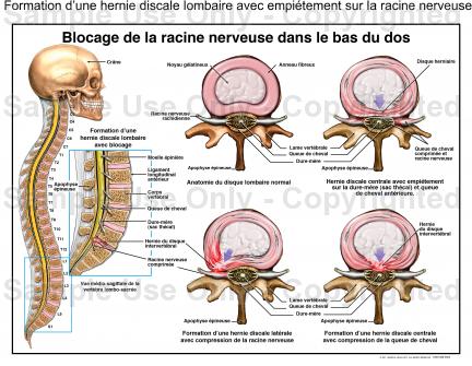 Le rhume à osteokhondroze du service cervical